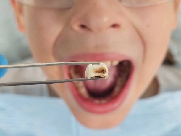 Best Emergency Tooth Extraction in Rosemead, CA